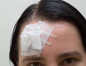 Head injury from a slip & fall personal injury lawsuit.